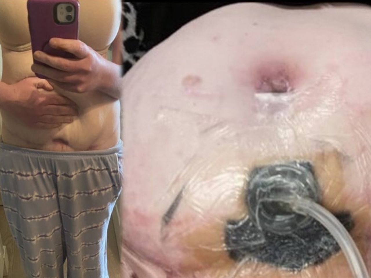 Shocking images reveal how nurse was mutilated after 'bargain deal' tummy  tuck in Turkey 