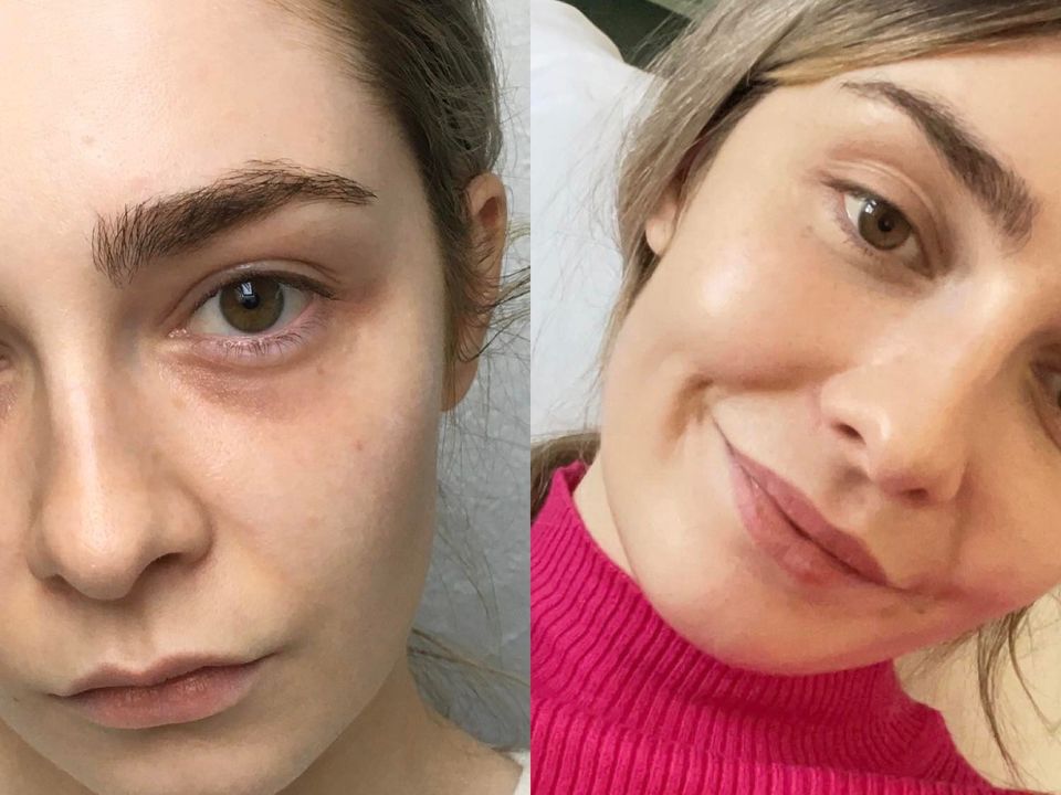 Karin before and after her treatment