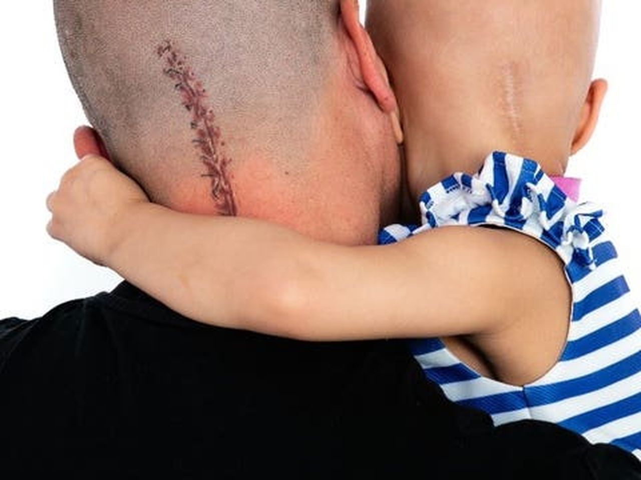 Man gets tattoo of daughter's brain surgery scar so she does not feel like  the 'odd one out' 
