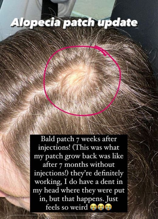 A close-up of Roz's alopecia patch after treatment