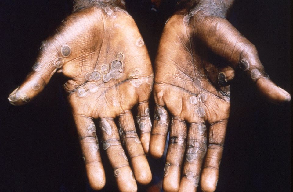Symptoms: Blisters are one of the signs of monkeypox