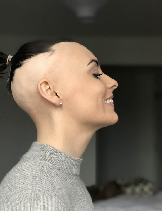 Chloe Sheehan struggled to look in a mirror when she lost most of her hair to alopecia