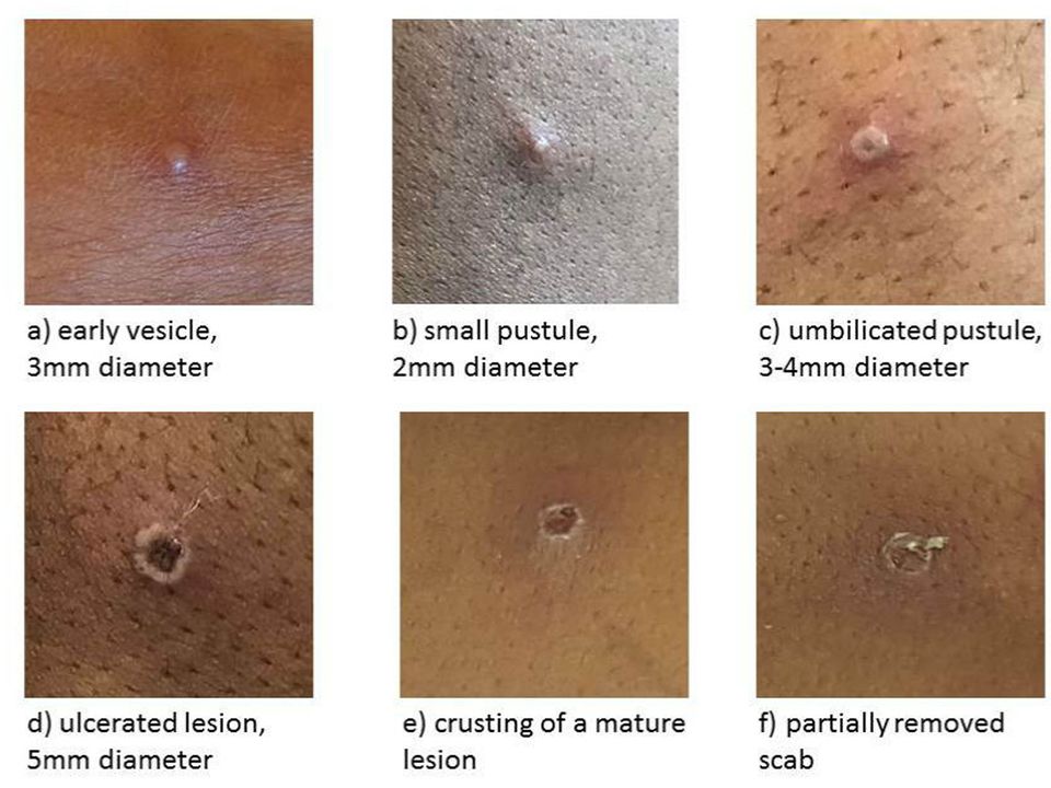The condition results in blisters on the body, which then scab over (UKHSA/PA)