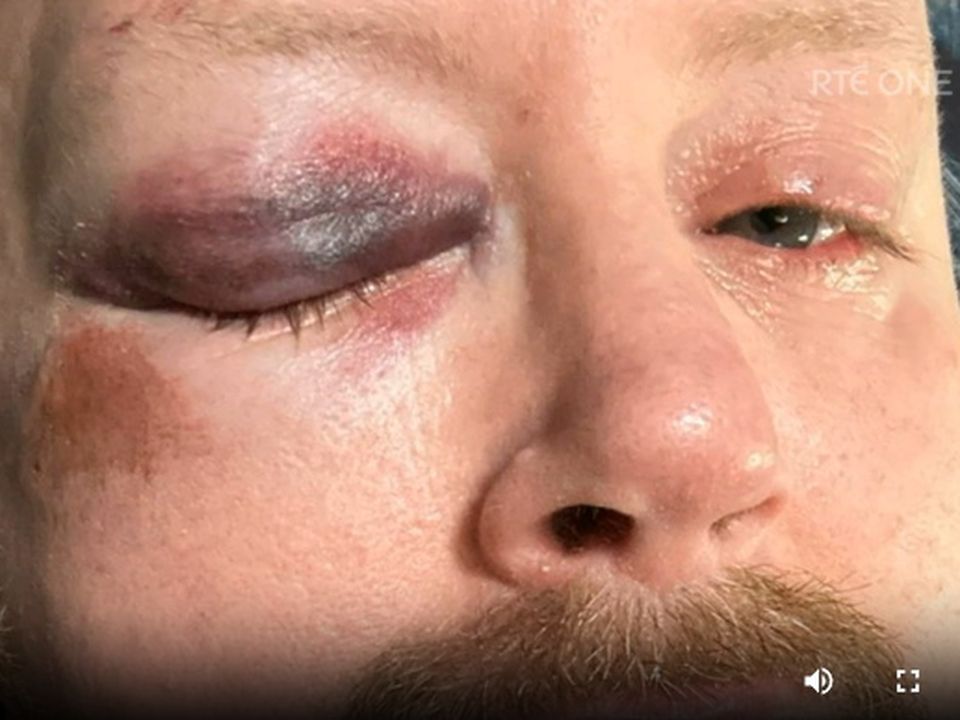 A close up of David's damaged eye.