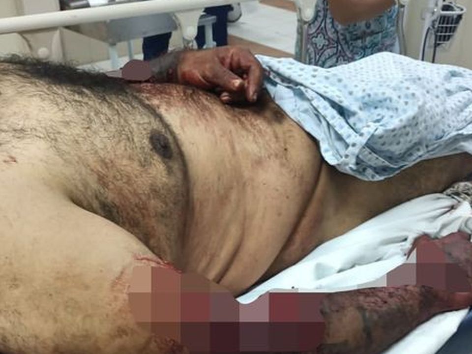 The injuries suffered after the hitman put his arm in the tiger's cage