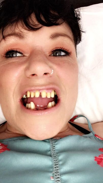 Dents Majila après un travail dentaire turc