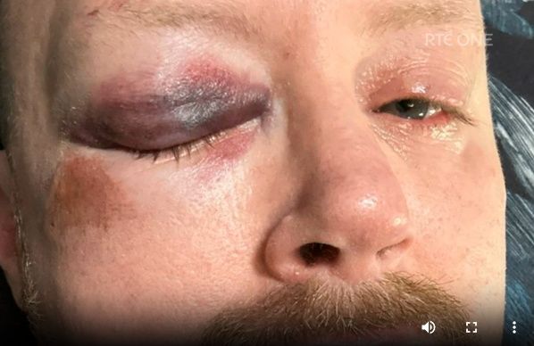 A close up of David's damaged eye.