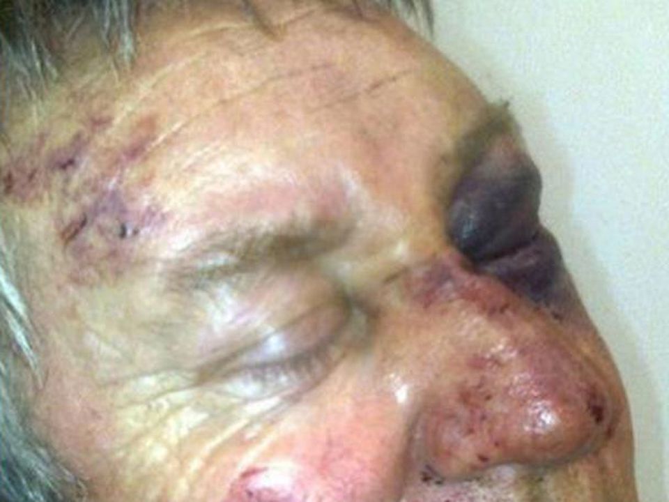 Martin McAllister suffered broken bones in his face, both his eye sockets were broken and he has lost his peripheral vision after Eugene Hanratty Snr (63) attacked him