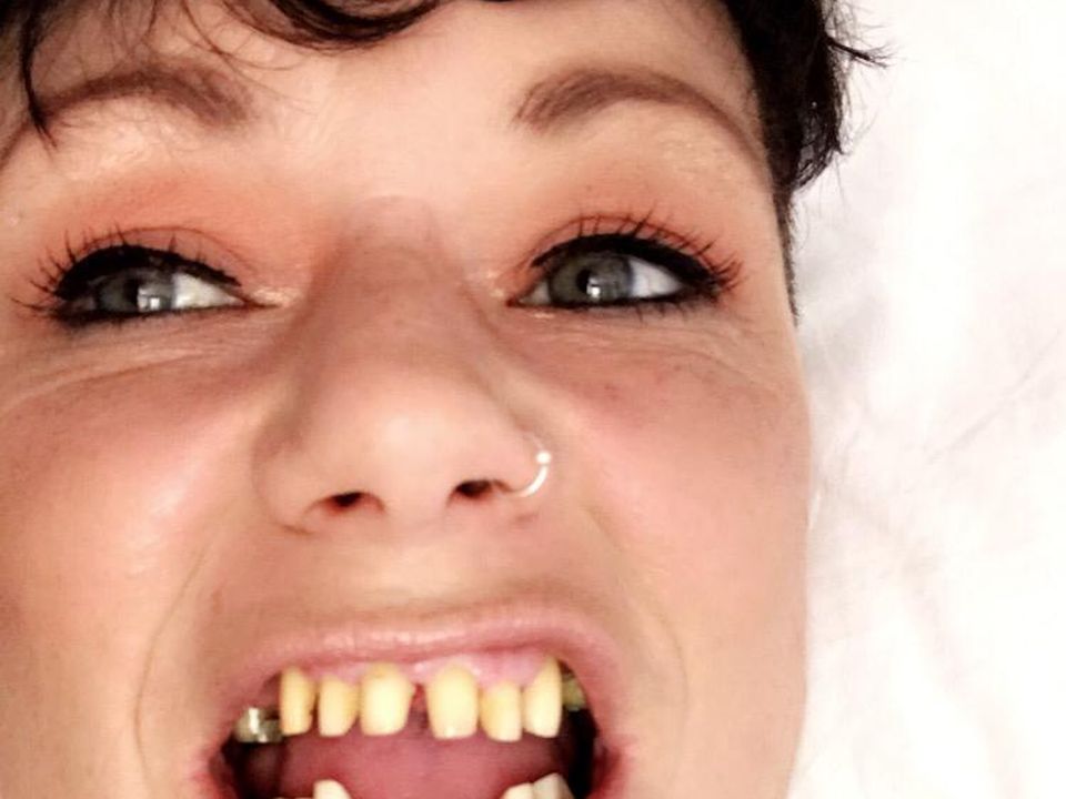 Majella’s teeth after the Turkish dentistry work