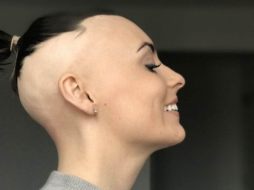 Chloe Sheehan struggled to look in a mirror when she lost most of her hair to alopecia