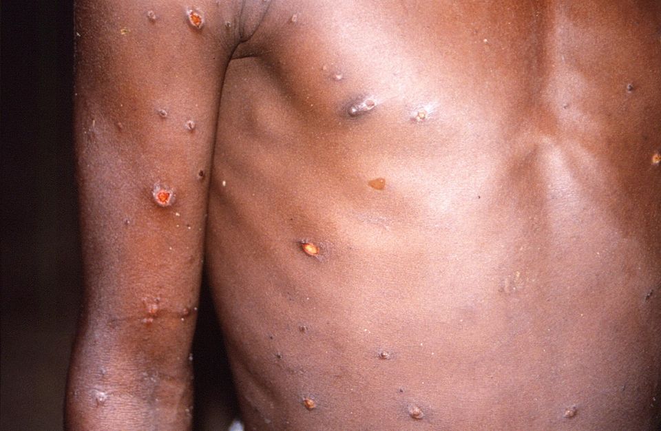 A man with monkeypox. Stock image