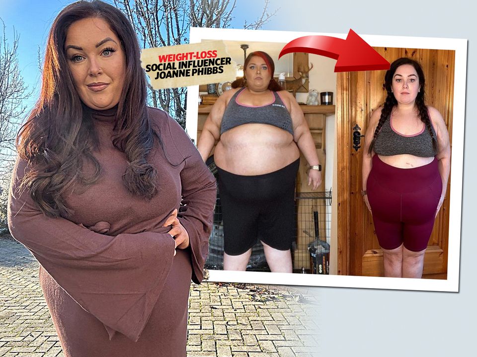 Joanne had lost eight stone prior to her gallbladder surgery