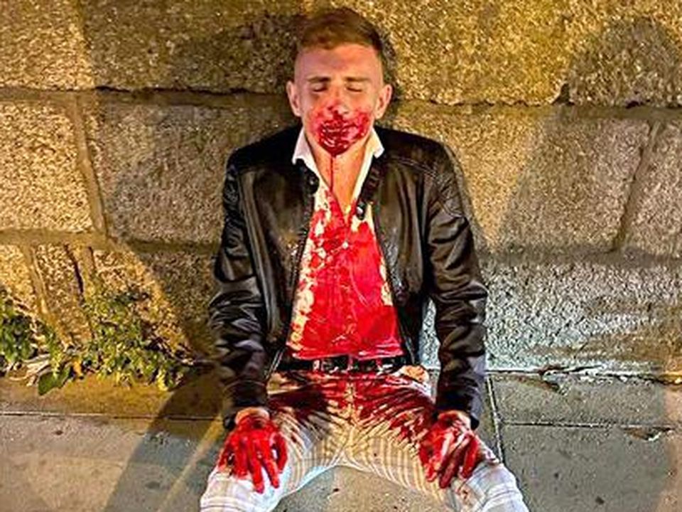 Jack Woolley after being attacked in Dublin city centre