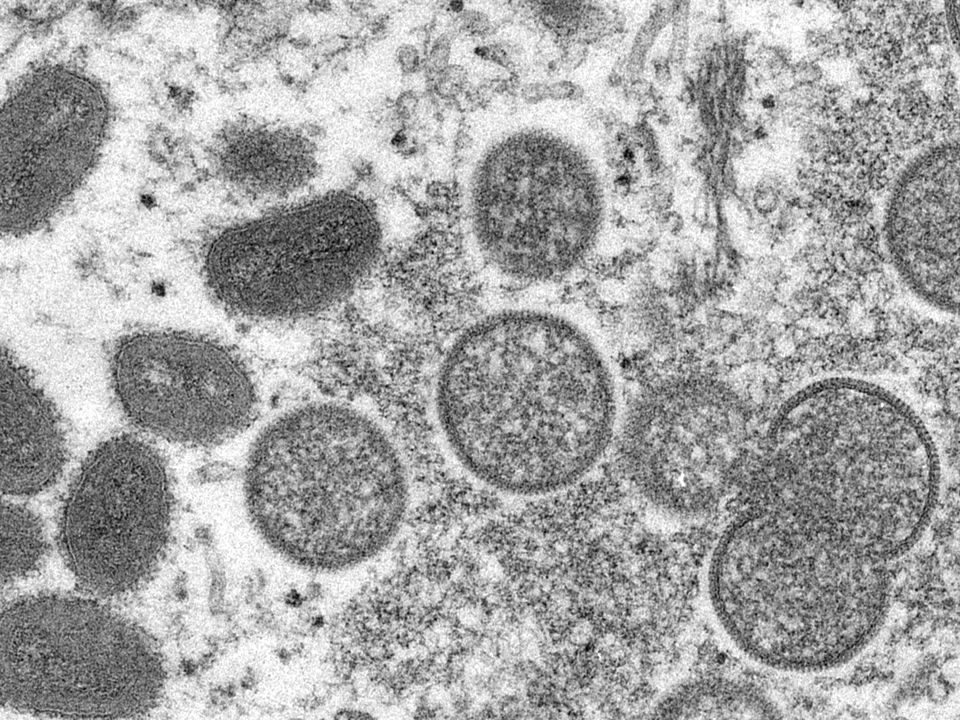 An electron microscope image shows monkeypox virions (Cynthia S Goldsmith, Russell Regner/CDC via AP)