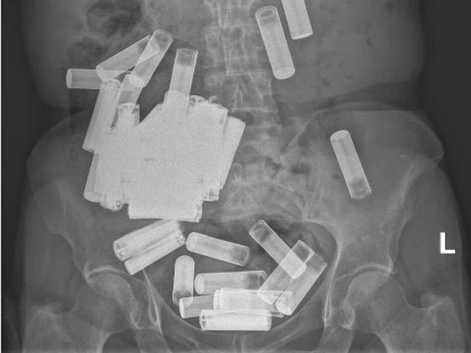 X-ray showing batteries in woman's stomach at St Vincent's Hospital