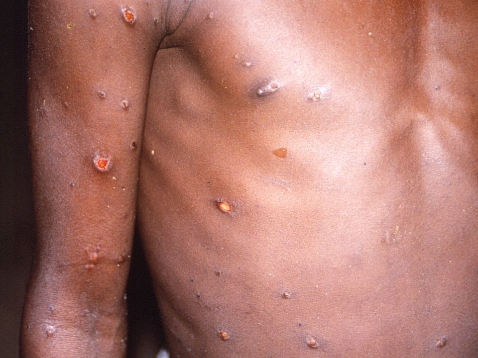 A patient with monkeypox