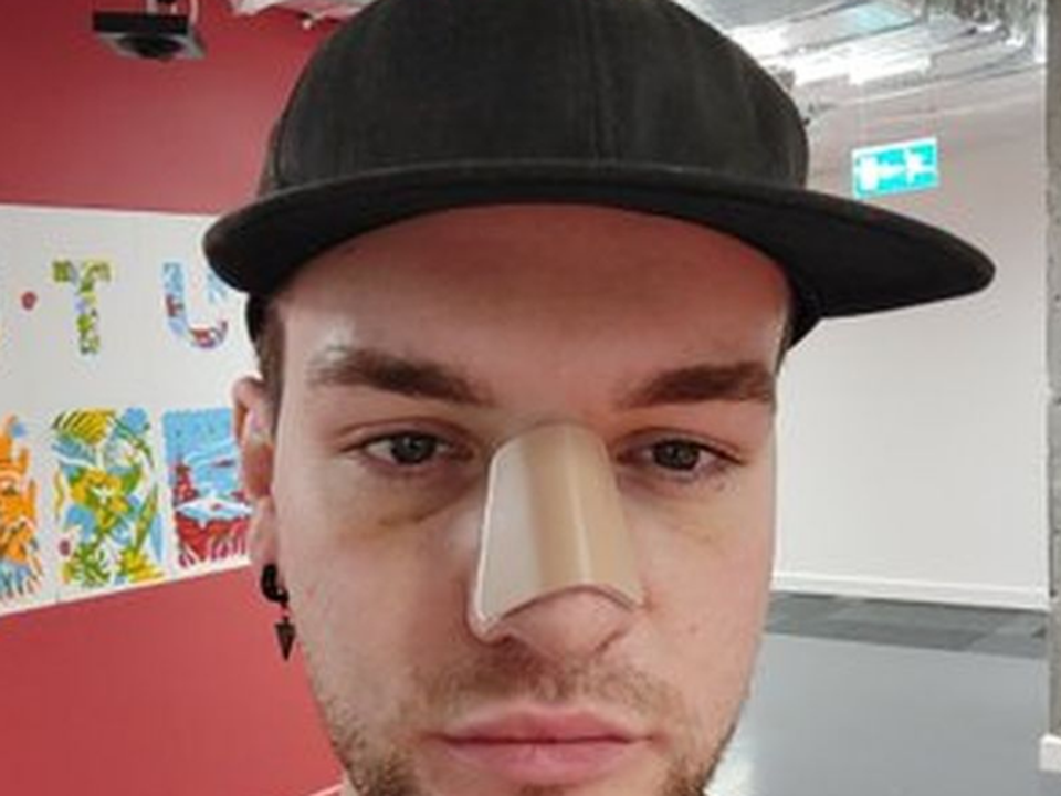 Mark had his nose aligned