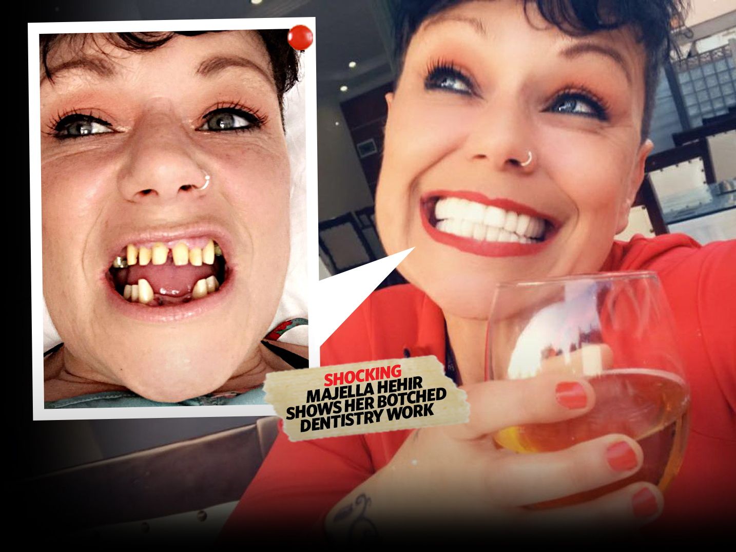 Une femme d’Offaly révèle comment un dentiste turc l’a laissée avec des « dents de requin »