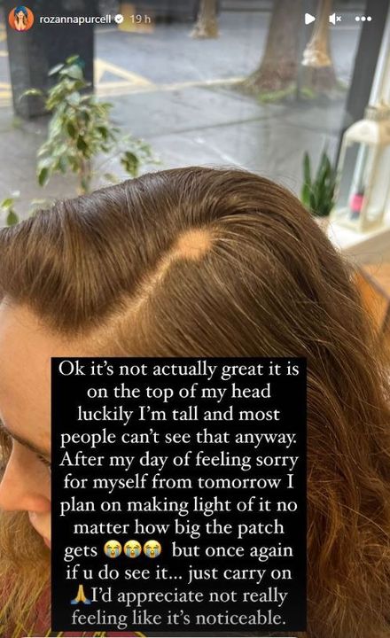 The influencer opened up to followers on Instagram about her alopecia.